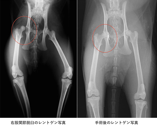 右股関節脱臼のレントゲン写真 手術後のレントゲン写真
