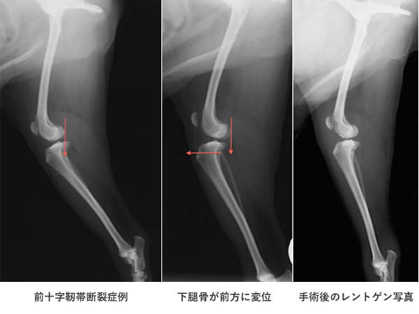 前十字靭帯断裂症例 下腿骨が前方に変位 手術後のレントゲン写真